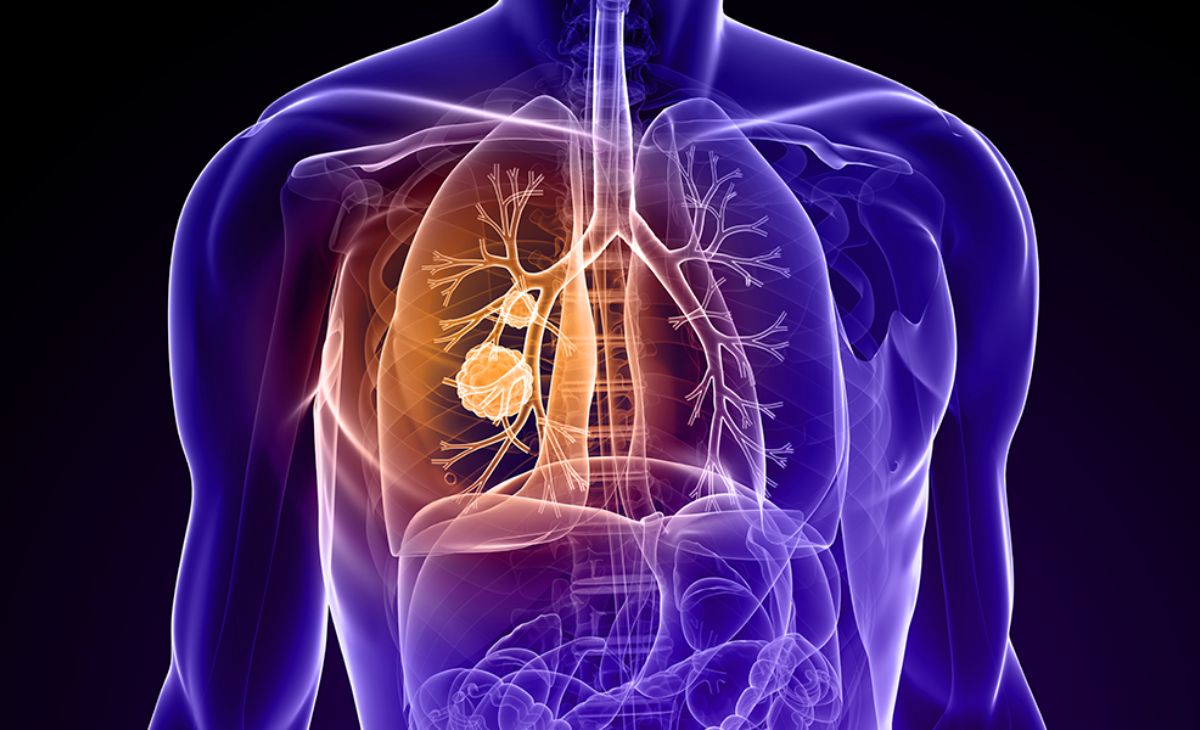 Lung Cancer’s Hidden Risks: Why Early Detection and Broader Awareness Are Crucial for Saving Lives