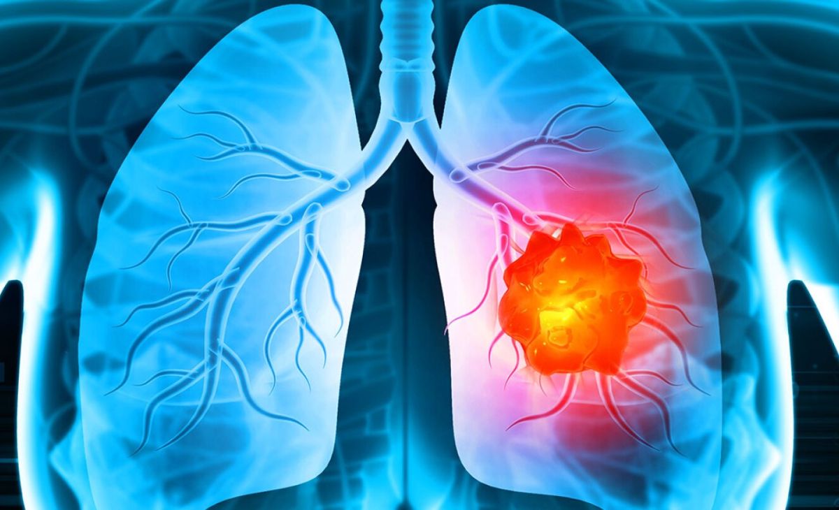 World Lung Cancer Day 2024: Debunking Myths About Lung Cleansing and Emphasizing Proven Prevention Strategies